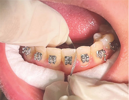 🥷 Mastering IPR with Clear Aligners: A Ninja-Level Guide