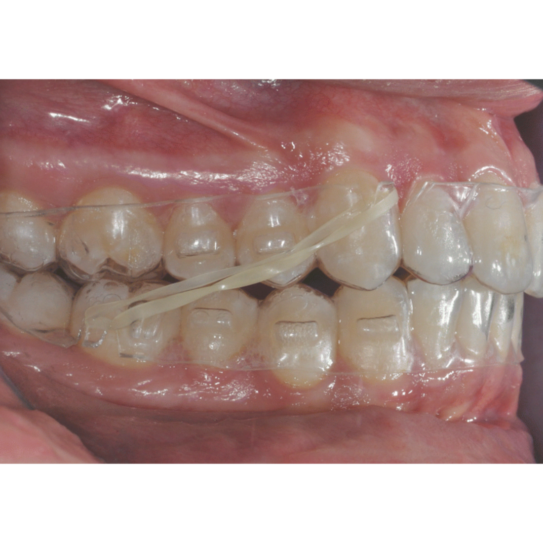 🥷Mastering Elastic Wear with Clear Aligners: A Ninja-Level Guide
