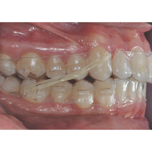🥷Mastering Elastic Wear with Clear Aligners: A Ninja-Level Guide